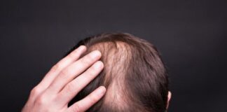 Cara Mengatasi Rambut Rontok Secara Alami